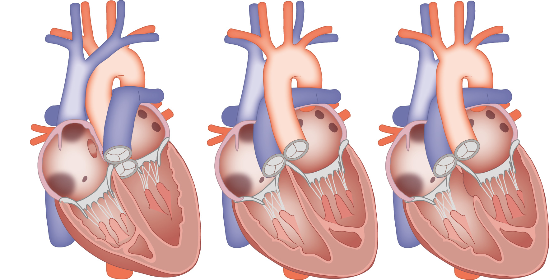 Leiden Drawing Congenital heart defects transposition of the great